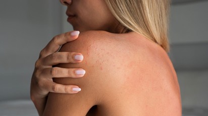 Ez a kellemetlen allergia az egész nyaralást tönkreteheti – amint jelentkezik árnyékba kell húzódni! című cikk nyitóképe