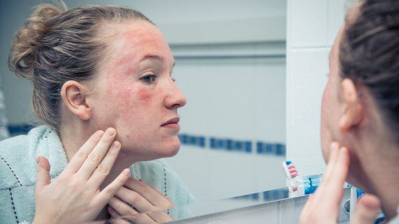 Mi a kivörösödött bőr erythema