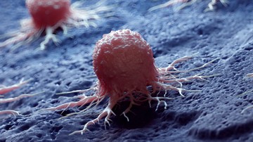 Amikor a daganat elszabadul: ezeket kell tudnia a rákos áttétekről