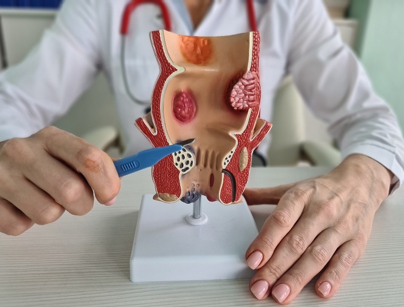 fájdalmas aranyér gyulladás ellen orvos mikor