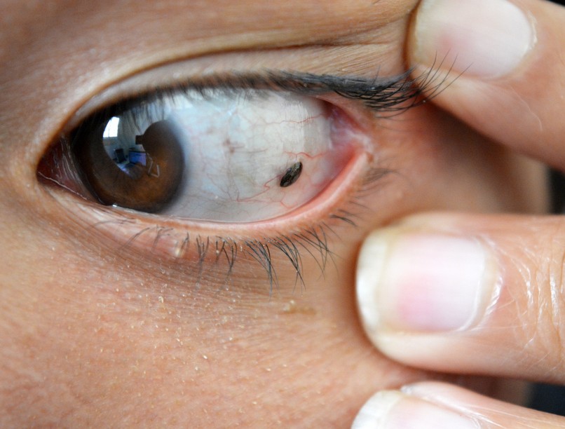 melanóma rák daganat áttét tünet szem