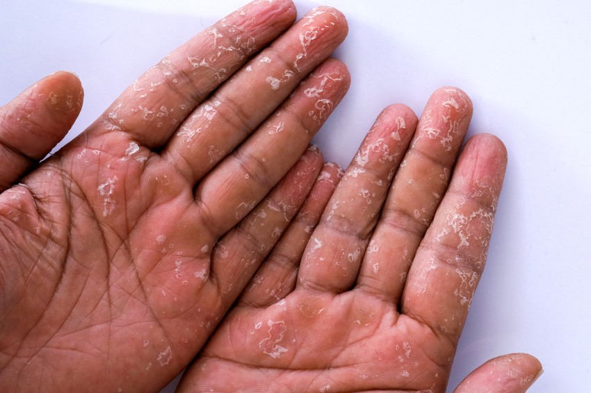 A toxikus sokk szindróma (TSS) egy súlyos, gyors lefolyású betegség, amelynek egyik jellemző tünete a diffúz bőrkiütés és a hámlás, ami a test számos részén megjelenhet.