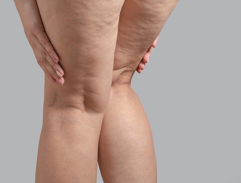 narancsbőr megszüntetése ellen módszer