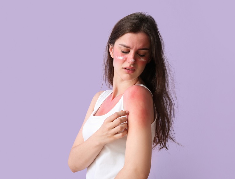 napégés, ellen házi módszer, természetes