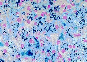 A hemokromatózis-világnap margójára