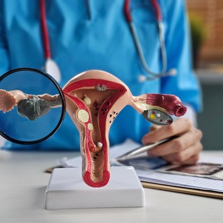 Milyen egy PCOS-vizsgálat? Lépésről lépésre: erre számíthat, ha felmerül a policisztás ovárium szindróma gyanúja című cikk nyitóképe