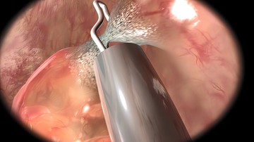 Ekkor lehet vastagbélpolipból rosszindulatú daganat 