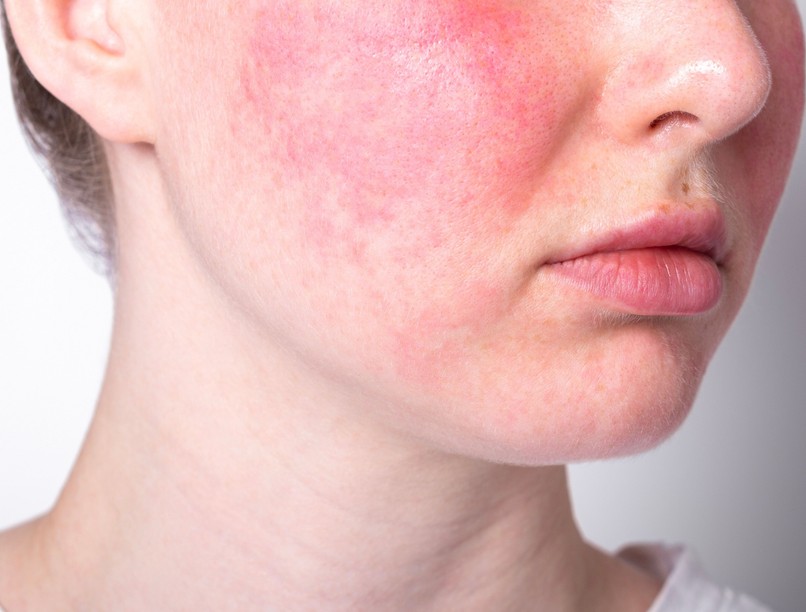 arc, piros ég oka, betegség