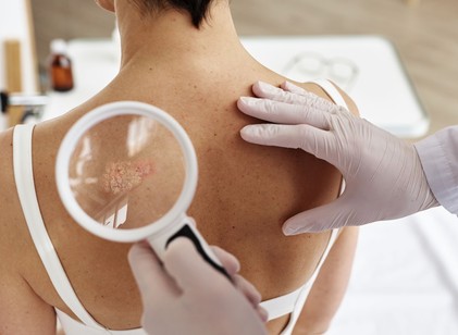 Áttörés a pikkelysömör kezelésében: jönnek a szájon át szedhető célzott terápiák című cikk nyitóképe