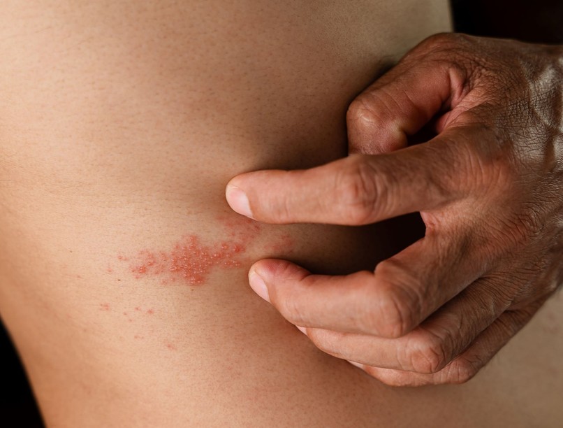 Övsömör vagy ekcéma tünetei varicella bárányhimlő