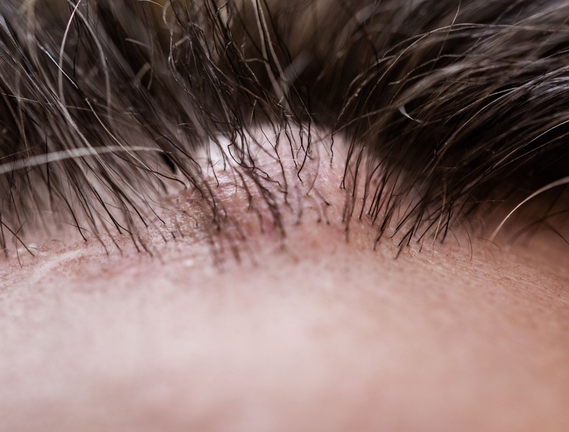 Rejtélyes dudor a bőrön: így szabaduljon meg a kásadaganattól