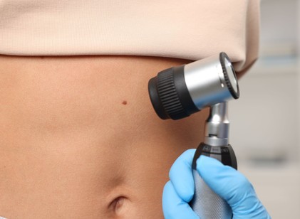 Veszélyes anyajegyek: 5 jel, ami miatt azonnal bőrgyógyászhoz kell fordulni című cikk nyitóképe