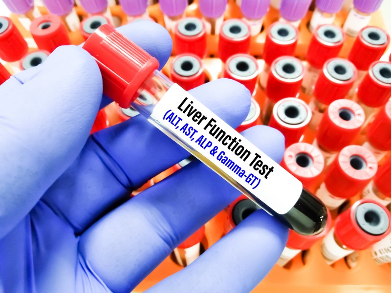 Mit jelent az AST (GOT) érték a laborleleten?