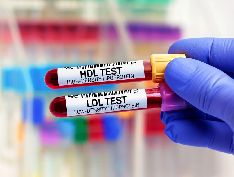 magas koleszterin vérzsír érszűkület ellen 