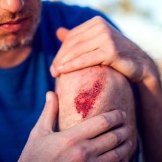 Vágások, horzsolások tünetei, vizsgálata és kezelése című cikk nyitóképe