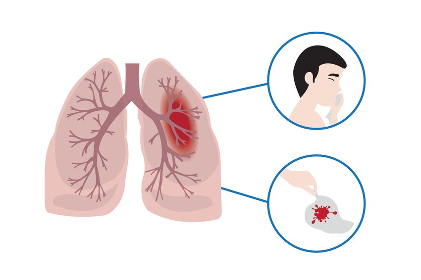 Leggyakrabban a tüdő szövetét, vagy érrendszerét érintő elváltozásai állhatnak a véres köpet hátterében, de számos más betegség is okozhatja.
