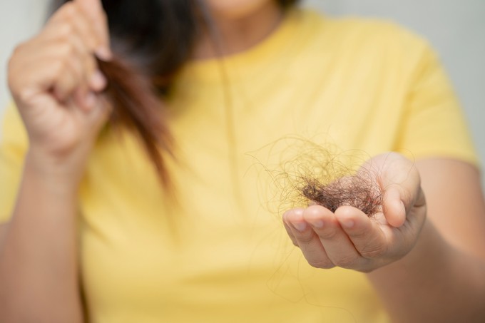 Nagyon hullik a hajam, hova menjek kivizsgálásra? Az orvos válaszol című cikk nyitóképe