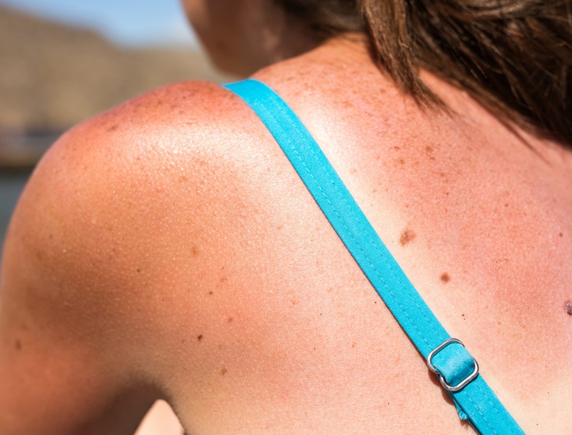 anyajegy napfény, melanóma, bőrrák