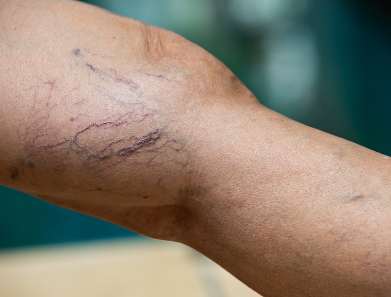 Mi a különbség a diozmin és a mikronizált diozmin között