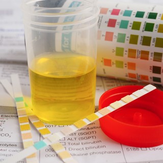 Mit jelez a magas vizelet fajsúly?Ártalmatlan jel vagy komoly figyelmeztetés? című cikk nyitóképe