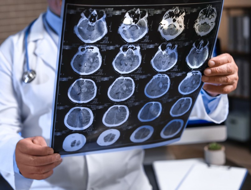 Alzheimer-kór gyógyszer EU kezelés Leqembi