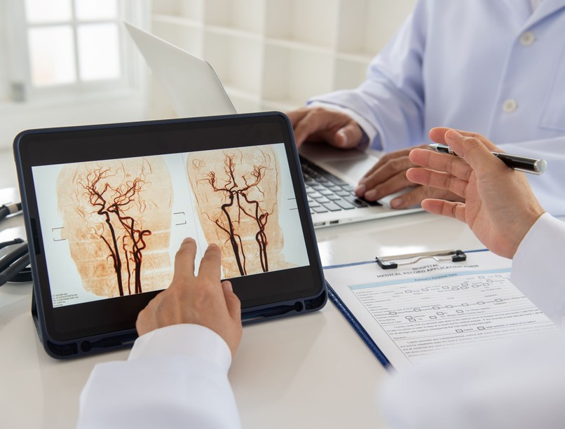 agyi infarktus agyvérzés stroke sztrók tünetei