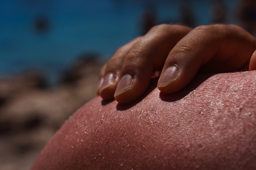 Ha nagyobb bőrfelületet érint a folyamat vagy hólyagképződéssel jár, és rossz közérzet kíséri, mindenképpen kórházi, szakorvosi ellátás szükséges. Egyes esetekben tetanusz elleni emlékeztető oltás vagy antibiotikus kezelésre is szükség lehet. A kiterjedten megégett bőrön keresztül nagyfokú lehet a folyadékvesztés, melyet infúziókkal pótolnak ilyen esetekben.