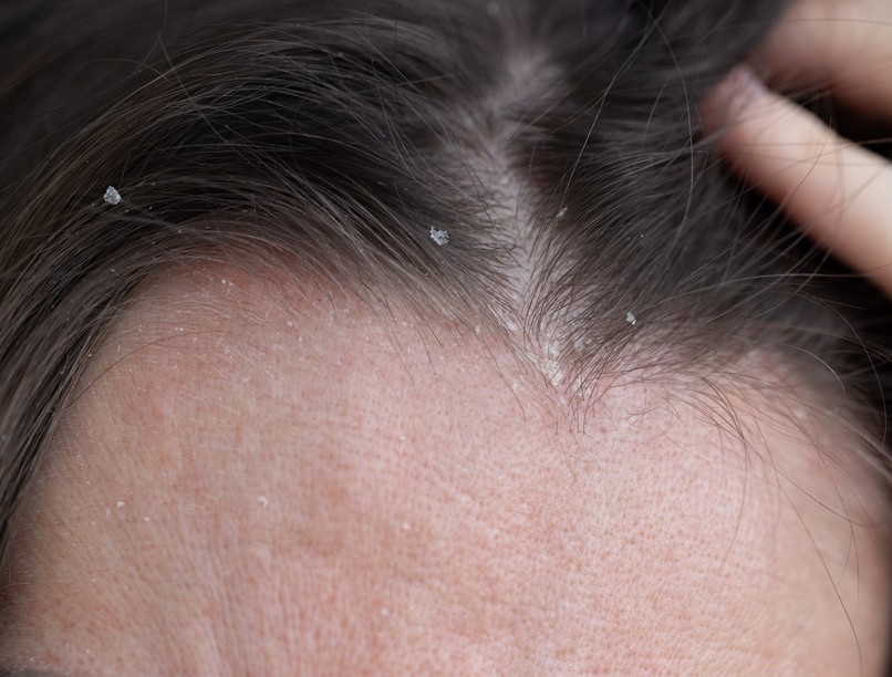 korpas zsiros haj oka száraz kezelés