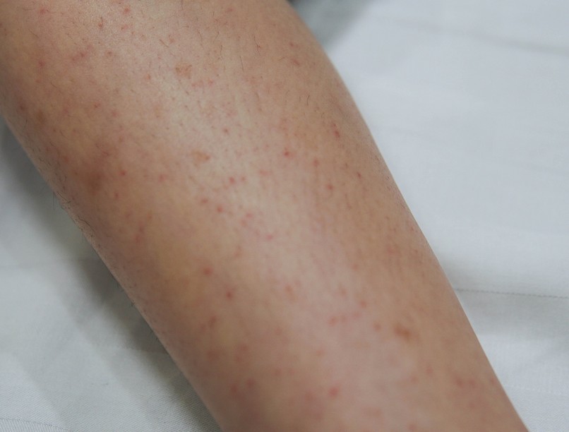 autoimmun gluténérzékenység, cöliákia bőr tünet