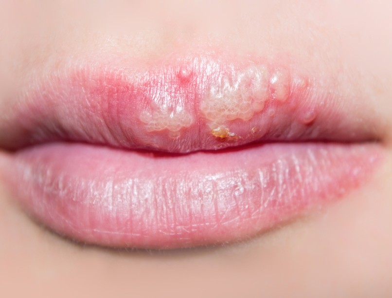 ajakherpesz, herpeszvírusok, herpes simplex, HSV-1, vírus, tünete, kezelése