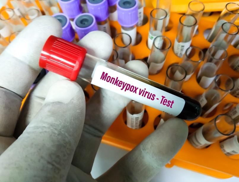 majomhimlő, vírus, himlő, tünetei, feketehimlő, kiütések