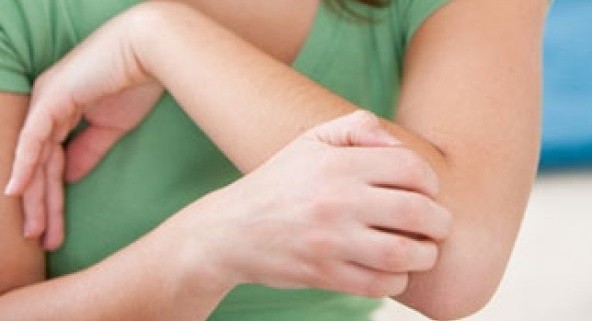 Tények és tévhitek az ekcémáról