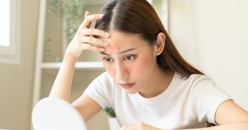  Súlyos autoimmun betegséget jelezhet az, ha így pirosodik ki az arcbőre 