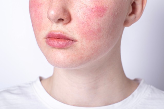 Piros erek az orron, érzékeny arcbőr: így lehet enyhíteni a rosacea tüneteit