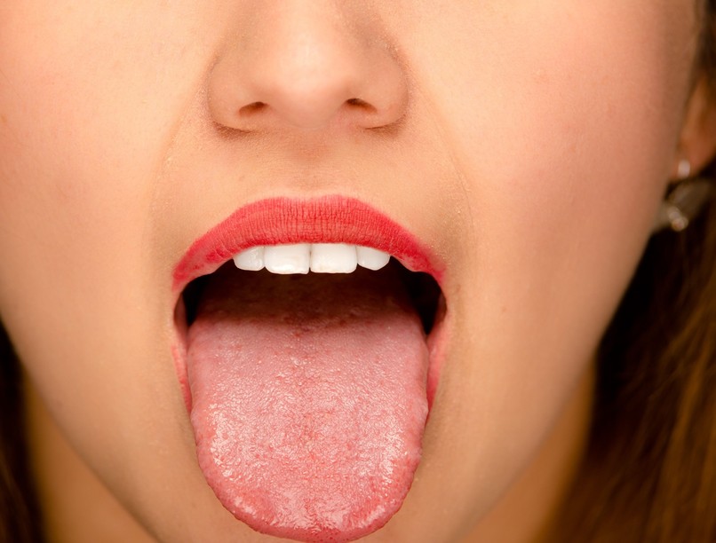 vashiány, furcsa, tünet, vérszegény nyelv