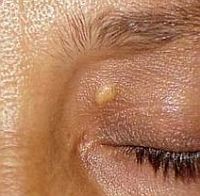 Koleszterincsökkentés: életmentés + spórolás...