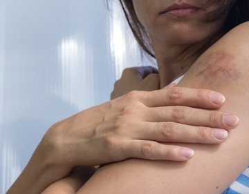 6. Zúzódások, vérzések