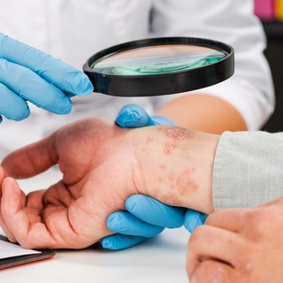 Ekcéma: oka, tünetei, orvosi és otthoni kezelési lehetőségei című cikk nyitóképe