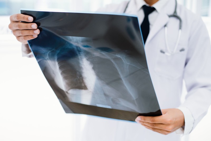 Tüdőrák: más tünetek jelentkezhetnek korai és késői stádiumban