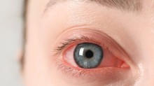 Kötőhártya-gyulladás esetén így nyerheti vissza leggyorsabban a szemei egészségét című cikk nyitóképe