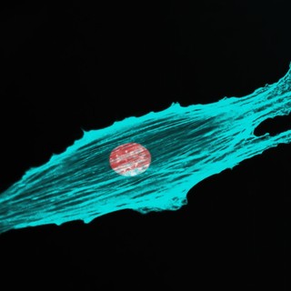 Megjósolhatóvá válhat az áttét? Új módszer jelezte, mekkora eséllyel képez áttétet a rák című cikk nyitóképe