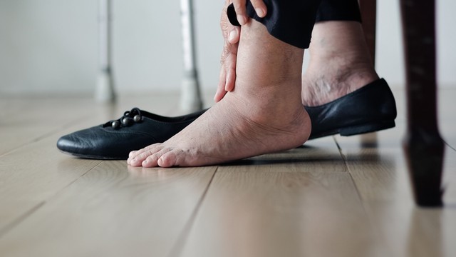 Lábdagadás, feszülés, nehézláb-érzés - mikor szükséges vénás ultrahang?