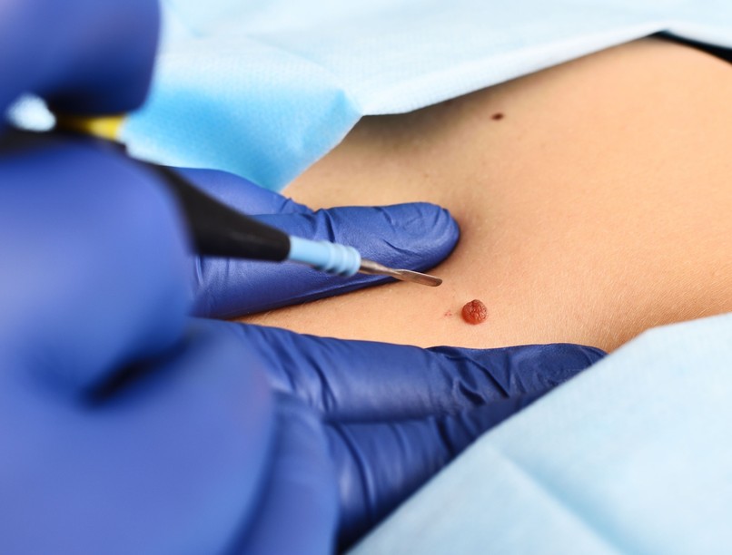 anyajegy, levétel eltávolítás bőrrák, melanóma