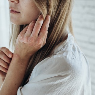 Ekcéma vagy pikkelysömör? Így különböztethető meg tünetek alapján a kettő című cikk nyitóképe