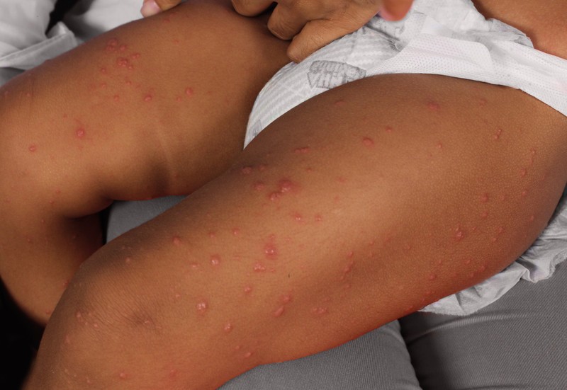 Gianotti-Crosti szindróma: tünete, vizsgálata és kezelési lehetőségei