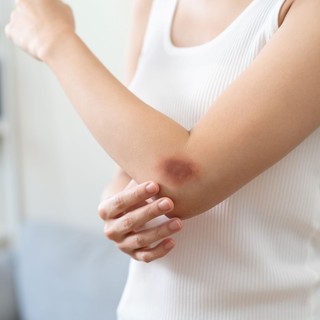 Az orvos szerint ez az apró változás a bőrön halálos vérrákot is jelezhet című cikk nyitóképe