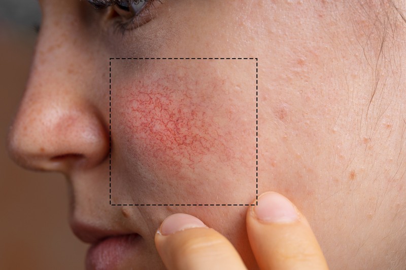 Rosacea - ezekre figyeljen a nyáron, hogy ne lobbanjanak be a tünetek