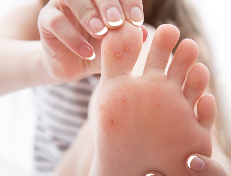 bőrkeményedés tyúkszem talp cukorbetegség diabétesz