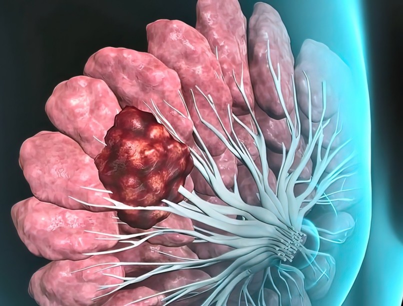 mellrák, emlőrák, daganat, rákbetegség