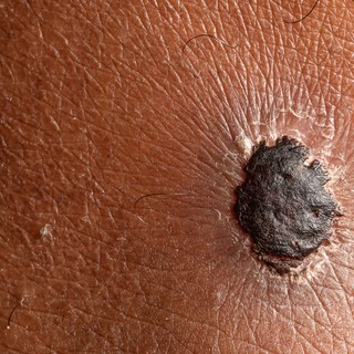 A melanóma első jelei: mit vegyen komolyan, és hogyan ismerheti fel időben a bőrrákot? című cikk nyitóképe